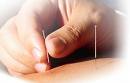 Akupunkturni tretman
